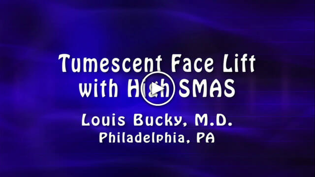 Tumescent Face Lift with High SMAS by Louis Bucky, M.D.