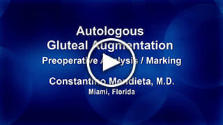 Autologous Gluteal Augmentation Preoperative Analysis/Marking by Constantino Mendieta, M.D.