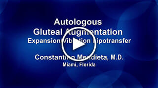Autologous Gluteal Augmentation - Expansion/Vibration Lipotransfer by Constantino Mendieta, M.D.