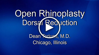 Open Rhinoplasty Dorsal Reduction by Dean Toriumi, M.D.