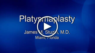 Dr. Stuzin: Platysmaplasty Procedure