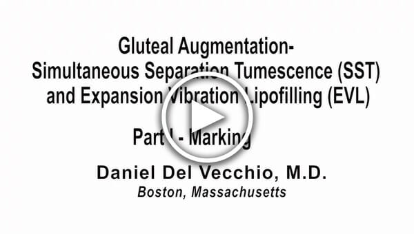 Dr. Del Vecchio: Gluteal Augmentation Part 1 - Marking