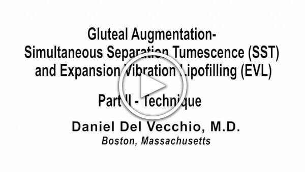 Dr. Del Vecchio: Gluteal Augmentation Part 2 - Technique