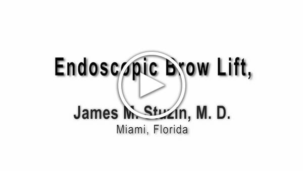 Dr. Stuzin: Endoscopic Brow Lift