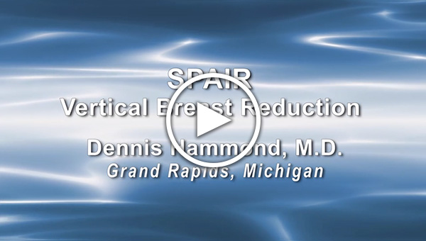 Dr. Dennis Hammond: SPAIR Vertical Breast Reduction