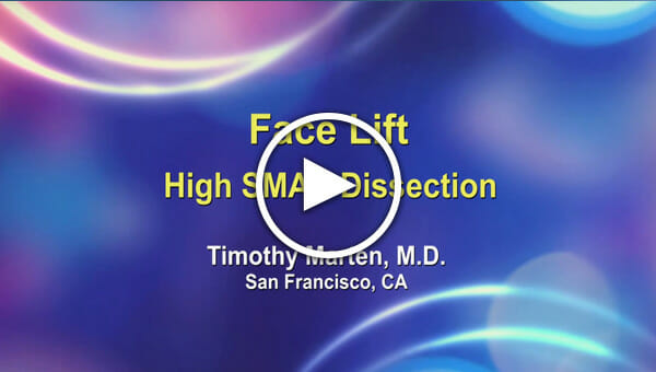 Dr. Timothy Marten: Face Lift High SMAS Dissection