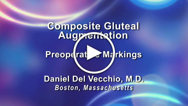Dr. Daniel Del Vecchio: Composite Gluteal Augmentation - Preoperative Marking