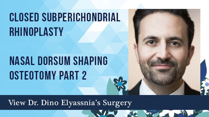 Closed Subperichondrial Rhinoplasty Part 2 - Nasal Dorsum Shaping Osteotomy #2