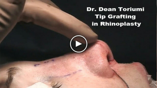 Rhinoplasty Tip Grafting by Dean Toriumi, M.D.