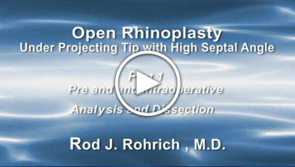 Dr. Rohrich: Open Rhinoplasty - Under Projecting Tip with High Septal Angle Part 1