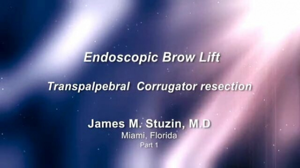 Dr. James M. Stuzin: Endoscopic Brow Lift Part 1