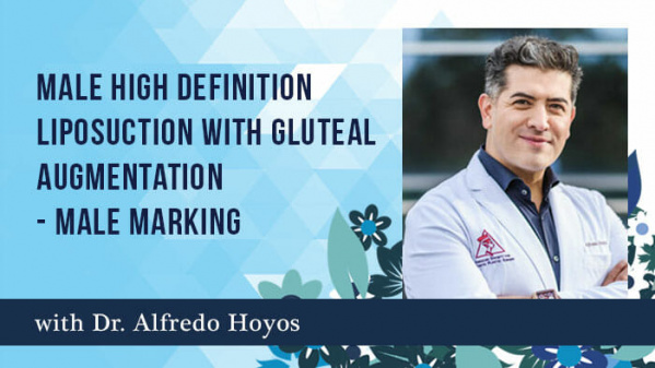 Male High Definition Liposuction with Gluteal Augmentation - Male Marking