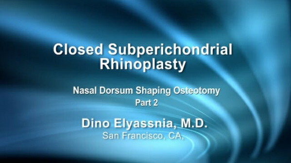 Closed Subperichondrial Rhinoplasty Part 2 - Nasal Dorsum Shaping Osteotomy