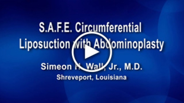 S.A.F.E Circumferential Liposuction with Abdominoplasty by Simeon H. Wall, Jr., M.D.