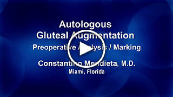 Autologous Gluteal Augmentation Preoperative Analysis/Marking by Constantino Mendieta, M.D.