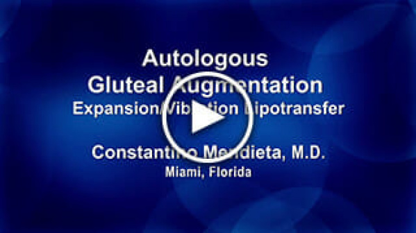 Autologous Gluteal Augmentation - Expansion/Vibration Lipotransfer by Constantino Mendieta, M.D.