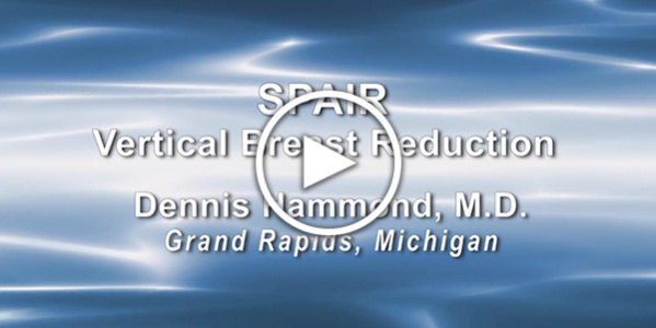 Dr. Dennis Hammond: SPAIR Vertical Breast Reduction
