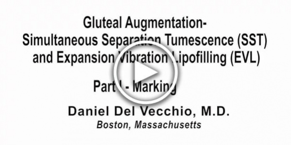 Dr. Del Vecchio: Gluteal Augmentation Part 1 - Marking